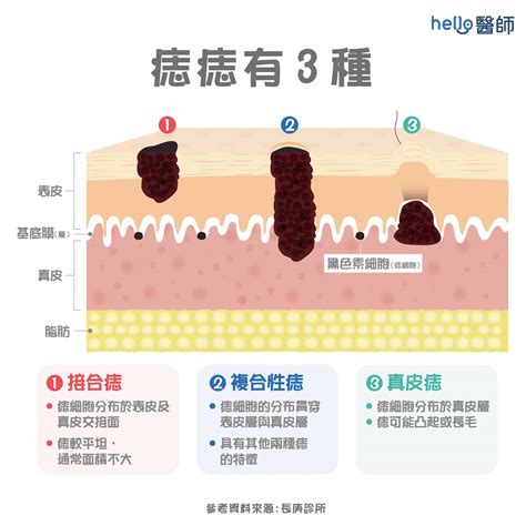 突然長痣原因